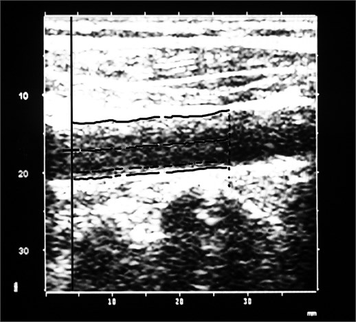Carotid intima-media thickness measurement with ImageJ software (a) and ArtLab system (b)