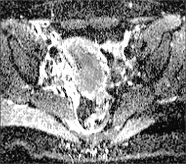 Cervical cancer: a) DW–MRI (b value 400 s/mm2) shows hyperintense tumor (white arrow), b) corresponding ADC is low (0.545×10-3 mm2/s) (black arrow)