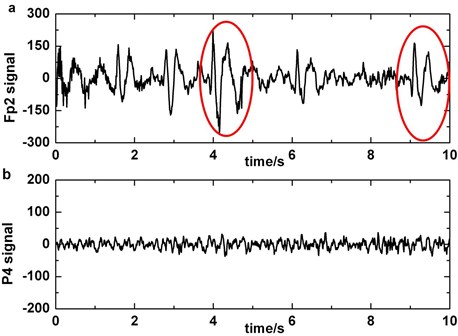a) The original EEG signal which contains blinking artifacts in Fp2 (blinking which pollute P4 channel’s signals is circled), b) the original data which do not contain slow-waves in P4, c) third order of wavelet coefficients of the signal which is preprocessed by blinking cancelling method in P4, d) third order of wavelet coefficients of the original signal which do not have to be preprocessed in P4