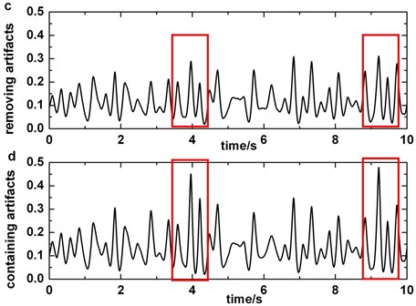 a) The original EEG signal which contains blinking artifacts in Fp2 (blinking which pollute P4 channel’s signals is circled), b) the original data which do not contain slow-waves in P4, c) third order of wavelet coefficients of the signal which is preprocessed by blinking cancelling method in P4, d) third order of wavelet coefficients of the original signal which do not have to be preprocessed in P4