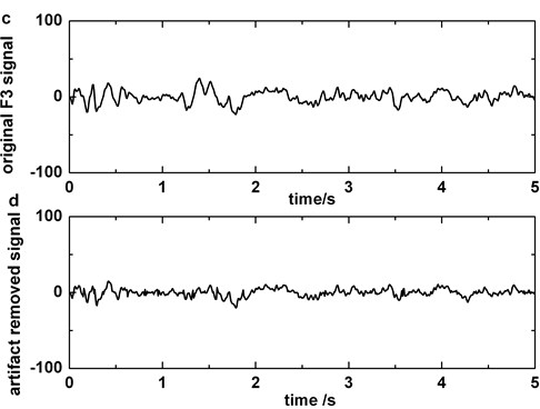 a) Original EEG signal which contains blinking in Fp1, b) original EEG signal which contains blinking in Fp2, c) original EEG signal polluted by blinking in F3, d) the EEG signal processed by artifact cancelling method in F3. Blinkings in Fp1 and Fp2 are boxed in boxes