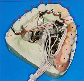 Test prosthesis with highlighted load application points (23-27)
