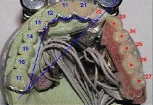 Test prosthesis with highlighted load application points (23-27)