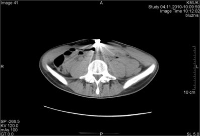 CT scans axial projection of the same patient: a) metal artifact on the abdominal wall projection,  b) CT topogram with clearly visible origin of artifact – navel ring, surrounded by a circle