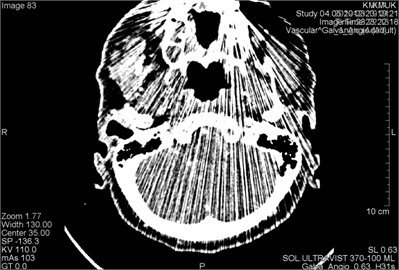 CT scans axial projection: a) intense metal artifacts and bone window of the same patient,  b) visible artifacts caused by multiple dental crowns