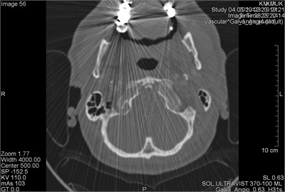 CT scans axial projection: a) intense metal artifacts and bone window of the same patient,  b) visible artifacts caused by multiple dental crowns