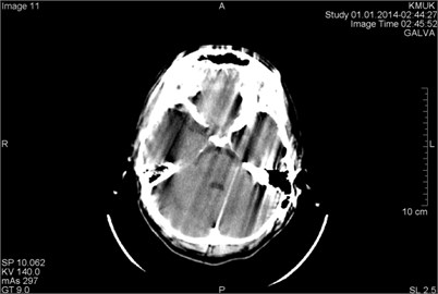 CT scans axial projection on the same patient (different slices). In both panels presented artifacts arising from the movement of the patient during the study