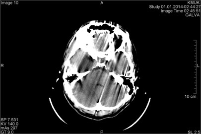 CT scans axial projection on the same patient (different slices). In both panels presented artifacts arising from the movement of the patient during the study