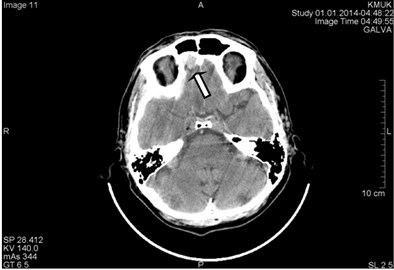 CT scans axial projection: a) motion artifacts cover the hemorrhage in the right frontal part of the brain (marked by arrow), b) very bright motion artifacts due to the patient’s active head  movement during the scan