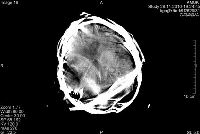 CT scans axial projection: a) motion artifacts cover the hemorrhage in the right frontal part of the brain (marked by arrow), b) very bright motion artifacts due to the patient’s active head  movement during the scan