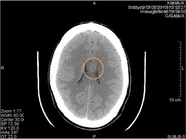 CT scans axial projection. a) Visible artifact caused by the CT machine tube failure (marked by a circle). After changing the tube artifact disappeared. b) CT scan axial projection with analogical  artifact caused by the hardware problems (surrounded by a circle).  This artifact can be easily confused with a brain lesion