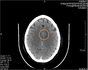 CT scans axial projection. a) Visible artifact caused by the CT machine tube failure (marked by a circle). After changing the tube artifact disappeared. b) CT scan axial projection with analogical  artifact caused by the hardware problems (surrounded by a circle).  This artifact can be easily confused with a brain lesion