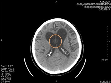 CT scans axial projection on the same patient: a) visible hardware-depended origin artifact  marked by circle, b) another CT slice. Artifact disappeared
