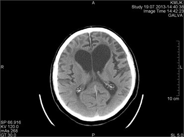 CT scans axial projection on the same patient: a) visible hardware-depended origin artifact  marked by circle, b) another CT slice. Artifact disappeared