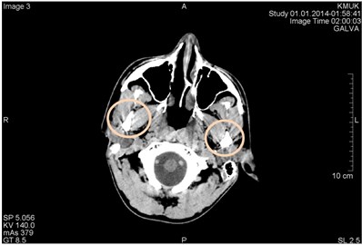 CT scans axial projections in different levels of the head of the same patient.  Visible beam hardening artifacts generated between high-density objects:  a) surrounded by circles, b) marked by arrows