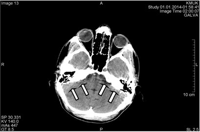 CT scans axial projections in different levels of the head of the same patient.  Visible beam hardening artifacts generated between high-density objects:  a) surrounded by circles, b) marked by arrows