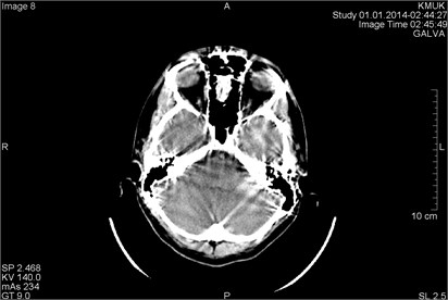 CT scans axial projection: visible intense beam hardening artifacts