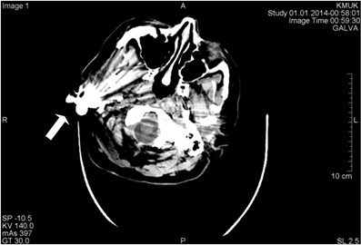 CT scans axial projection. Visible bright metal artifacts arising from the right ear  (marked by arrows)