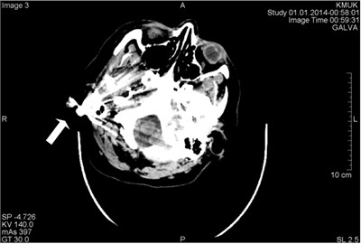 CT scans axial projection. Visible bright metal artifacts arising from the right ear  (marked by arrows)