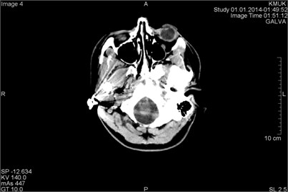 CT scans axial projection: a) visible bright metal artifacts arising from the right ear,  b) CT topogram, where origin of the artifacts are earrings (surrounded by circles)