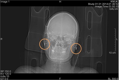 CT scans axial projection: a) visible bright metal artifacts arising from the right ear,  b) CT topogram, where origin of the artifacts are earrings (surrounded by circles)