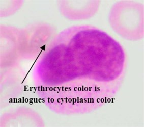Blast region segmentation difficulties in AML: a) erythrocytes color is analogues to M3 cytoplasm color, b) M3 blast with vitreous cytoplasm, c) M7 with protrusion cytoplasm