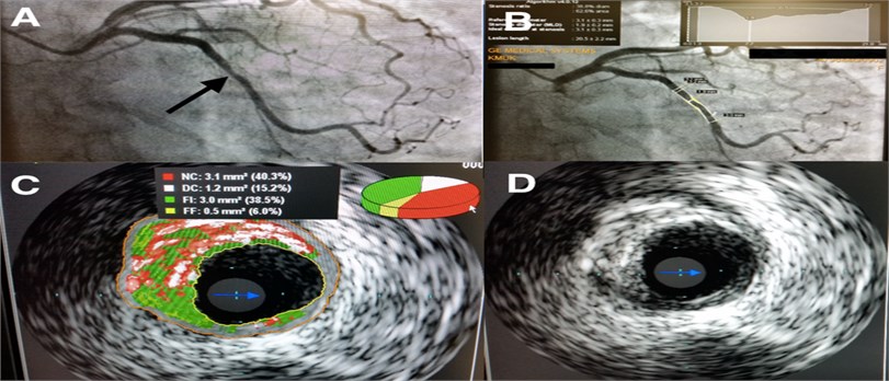 a) Typical view of CAA (Place of stenosis marked with black arrow); b) quantitative coronary angiography view; c) evaluation of the plaque using IVUS-VH; d) evaluation of the plaque using IVUS