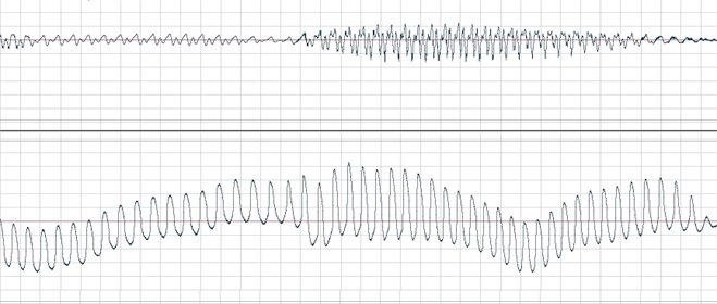 Temporary acoustic signal waveforms (upper) and EGG (bottom graph), stuttering clonic