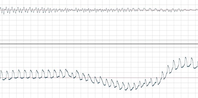 Temporary acoustic signal waveforms (upper) and EGG (bottom graph), stuttering – embolofrazja