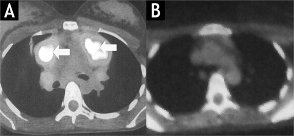 A 26-year-old female patient with histological confirmed Hodgkin’s lymphoma. PET/CT scan using [18] F-FDG radiopharmaceutical before (A) and after (B) treatment. Arrows show lymphoma masses with high FDG metabolism. No zones of high contrast accumulation were seen after treatment.