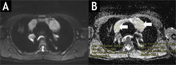 Diffusion-weighted MRIT1WIBE (A) and ADC map (B) of the same patient. White arrows show active tumour masses of high signal intensity with an average ADC value of 1.42×10-3 mm2s.