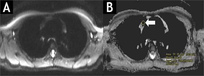 DW-MRIT1WIBE (A) and ADC map (B) of the same patient after chemotherapy course. No masses of high signal intensity are observed in DW images with b values of 50, 400 and 800 s/mm2.  In ADC map, the ADC value is lowering (immeasurable) in the former site of lymphoma masses.