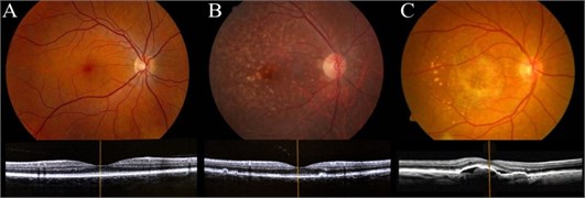 Color fundus photographs of the human retina performed with OPHTEK Visucam (top) and High-quality spectral-domain optical coherence tomography (SDOCT) images of the macula (bottom):  a) healthy eye, b) nonexudative AMD, c) exudative AMD