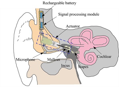 Schematic of the middle ear implant