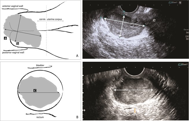 Measurements of invasive cervical carcinoma: a) sagittal plane and b) transverse plane
