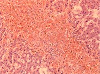 Images of liver tissue with plethora, dystrophy, cirrhosis and metastasis