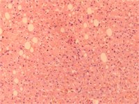 Images of liver tissue with plethora, dystrophy, cirrhosis and metastasis