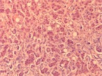 Images of liver tissue with plethora, dystrophy, cirrhosis and metastasis