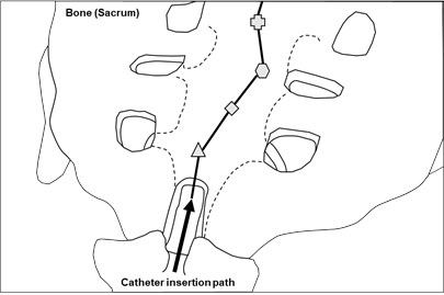 The catheter insertion path of epiduroscopy based on spatial cognitive learning