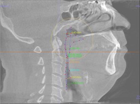 Computer 3D tomography of the upper breathing airways performed for the analysed patient B