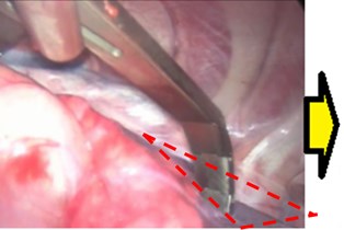 a) Target tissue obstructed by lung segment,  b) lung segment retracted-target tissue made accessible