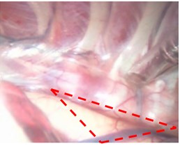 a) Target tissue obstructed by lung segment,  b) lung segment retracted-target tissue made accessible