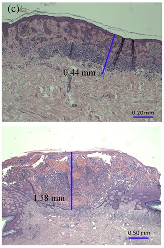 The thickness of: a) melanocytic nevi (above) and melanoma (below) estimated manually,  b) automatically using 22 MHz ultrasound, c) histologically by QCapture Pro 7 software