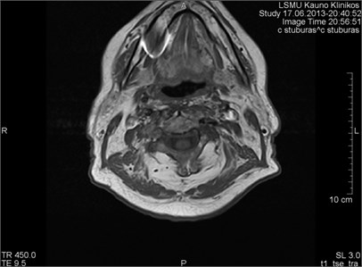 MRI axial projections. The metal artifact triggered by a dental crown is visible (marked by a circle)