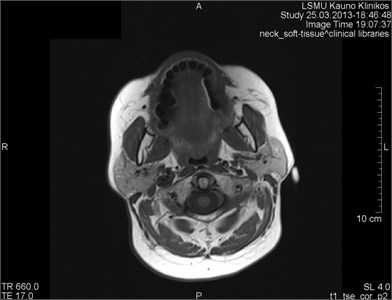 MRI axial projections. Numerous metal artifacts are visible  in the dental projection (marked by a circle)