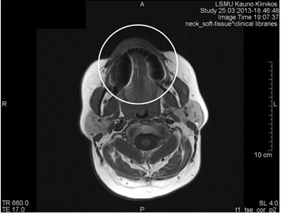 MRI axial projections. Numerous metal artifacts are visible  in the dental projection (marked by a circle)