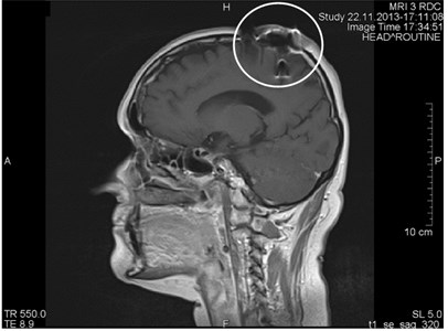 a) MRI axial projections. Artifacts triggered by foreign bodies are visible in the vertex projection.  b) Same patient. MRI sagittal projection. Artifacts triggered by foreign bodies  after the operation (marked by a circle)