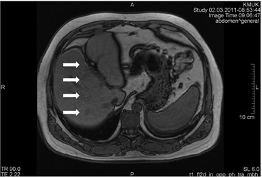 MRI axial projection. a) The patient took two cell phones into the scanning room. One was left  in the vault; the other was inadvertently taken by a patient. There was a call during  the scanning process which produced vertical “zipper” artifacts (marked by arrows).  b) Same patient, T1 sequence. “Zipper” artifact is marked by arrows