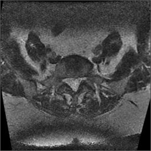 MRI axial projections. Visible slice overlap