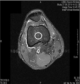 MRI axial projections. Pulsation artifacts are visible extending  in a horizontal line from the blood vessel (marked by circles)